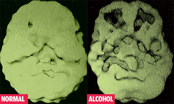 normal-alcohol-brain