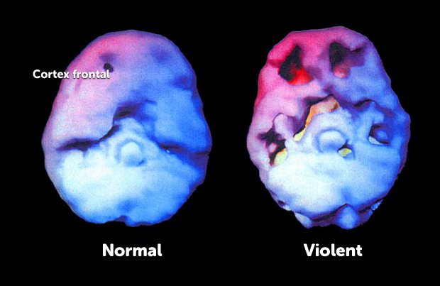 normal - violent brain